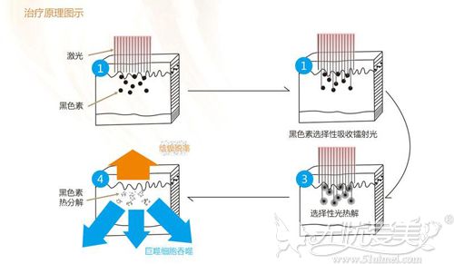 激光洗眉的过程原理