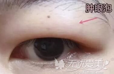 正常眼睛和肿泡眼有什么区别?怎样才能摆脱肿泡眼?