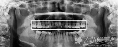 牙根短能做牙齿矫正吗？听说术后会导致牙齿脱落是真的吗