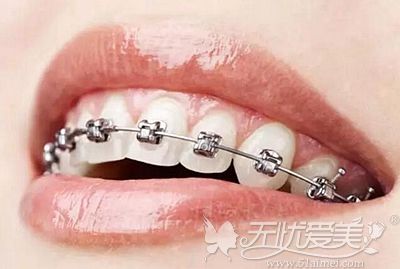 牙根短可以根据医生的方式进行牙齿矫正
