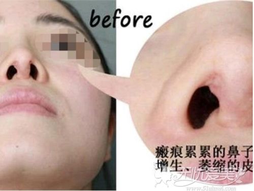 隆鼻2年后增生严重鼻头超级宽修复后会不会依旧增生
