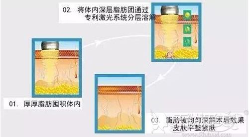 面部光纤溶脂的原理