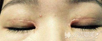 全切双眼皮术后出现疤痕增生