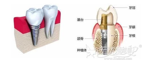 种植牙价格表上面都是几千到几万不等 这么贵是坑人的吗