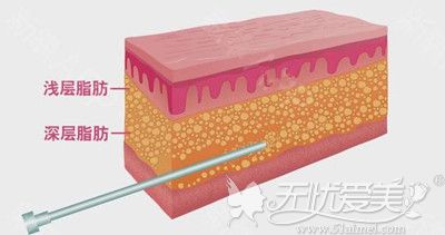 腰腹吸脂的手术原理