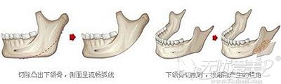 下颌角整形的手术原理