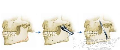 颧骨整形手术过程