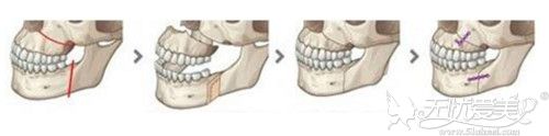 双鄂手术的原理解析
