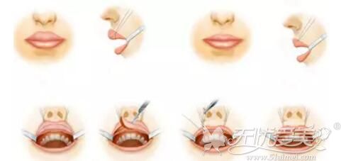 厚唇改薄术手术过程