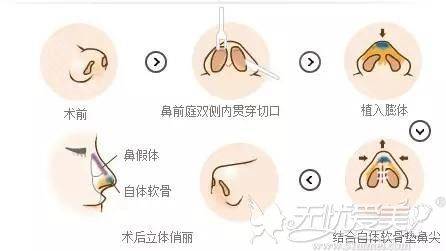 膨体隆鼻的植入过程