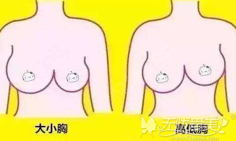 乳房天生大小不一样可以通过隆胸手术改善吗？