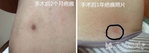 大腿吸脂手术后的疤痕