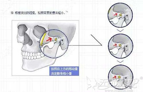 颧弓内推的极限