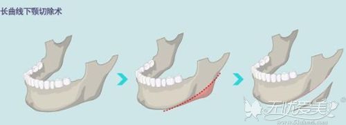 长曲线下颌角手术过程