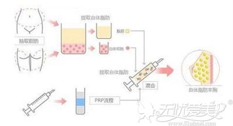 自体脂肪移植丰胸手术过程