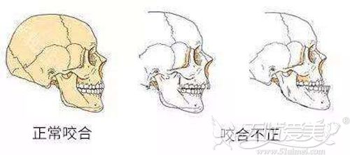一句话教你如何辨别双颚手术和突嘴手术有什么区别