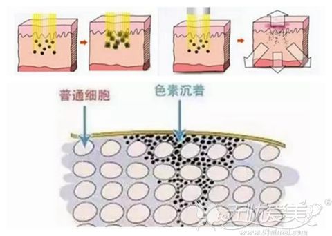 激光去雀斑会反黑吗