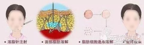 溶脂解决双下巴