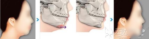 下巴截骨前移手术的对比