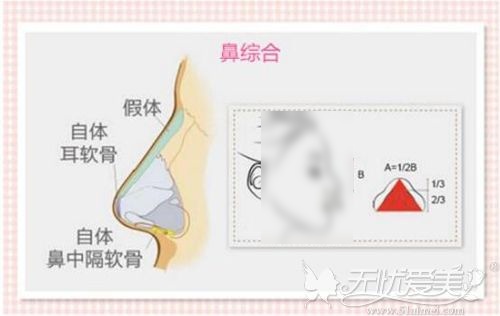 膨体鼻综合术后2年鼻子有点歪 取出重新做会导致鼻子变薄吗