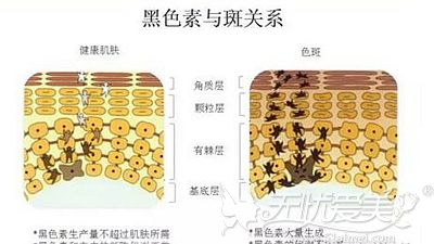 从M22和OPT激光的区别中明白谁是祛除雀斑和晒斑的小能手