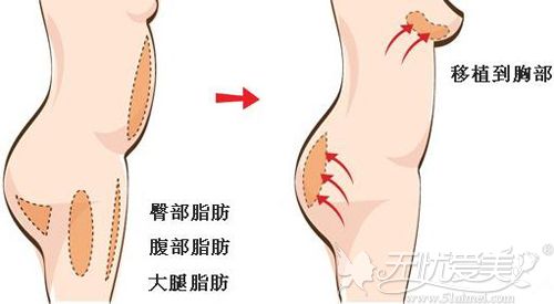 自体脂肪丰胸一次成型可信吗关键还要看脂肪存活率咋样