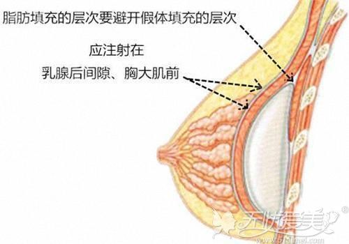 自体脂肪丰胸注射的位置