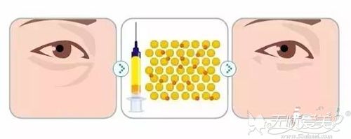 自体脂肪填充眼睛凹陷原理