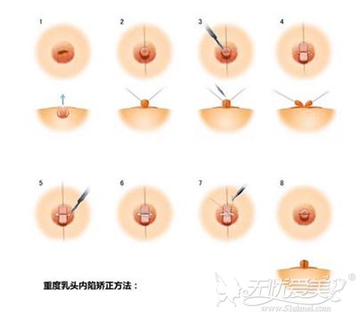 乳头再造术图片