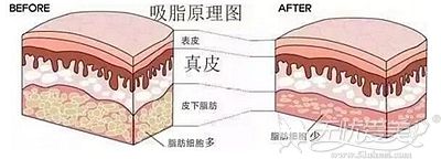 腰腹吸脂的手术原理