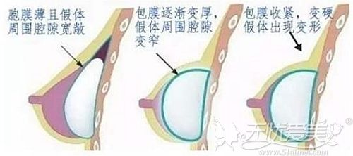 隆胸后产生的包膜挛缩