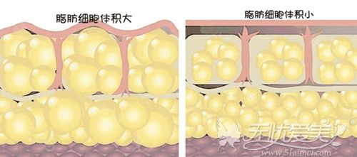 吸脂后细胞的变化