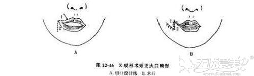 Z”成形术法大口改小整形术