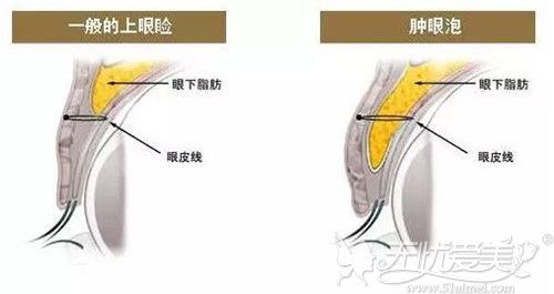 肿泡眼和一般眼睑上方的脂肪组织