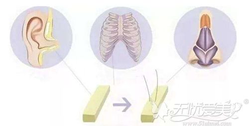 鼻综合手术用到的软骨材料