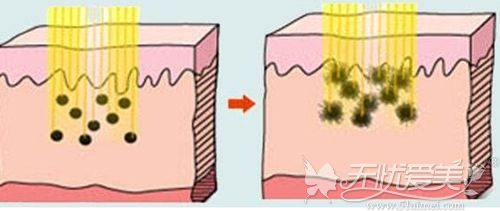 超皮秒美肤的原理