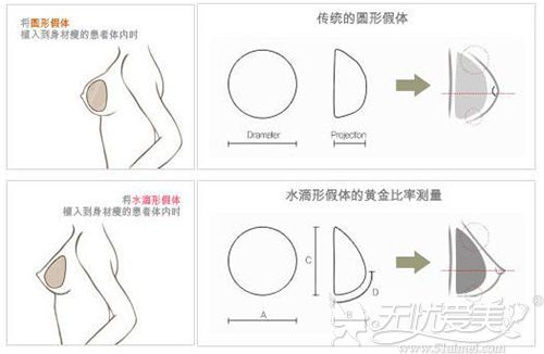 不同形状的隆胸假体