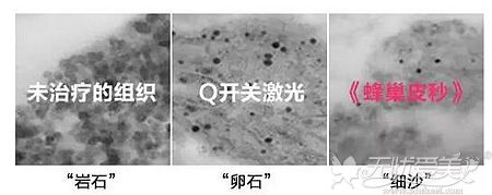 蜂巢皮秒激光和普通激光的区别