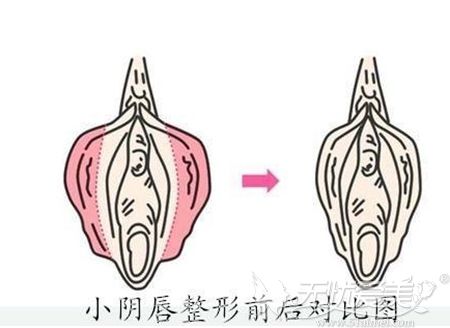 小阴唇手术可以改善阴唇肥大