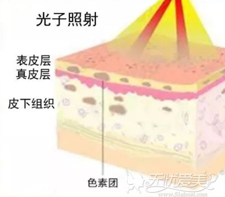 光子嫩肤结合刷酸不仅能祛痘还能抑制其生长