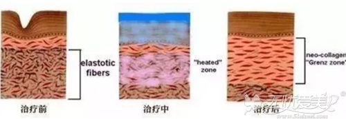 光子嫩肤去痘痘的过程