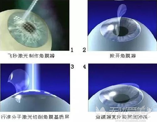近视眼手术过程
