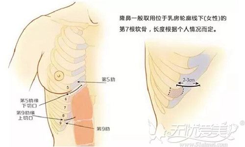 肋软骨隆鼻4个月后鼻子塌了是因为肋骨被吸收了吗