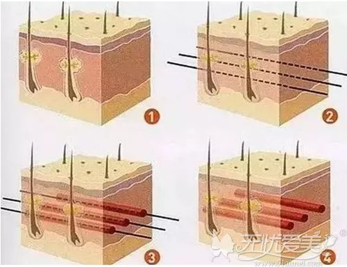 面部埋线提升的效果