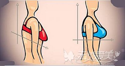 你胸下垂的轻重程度将会决定人工韧带乳房提升术的价格