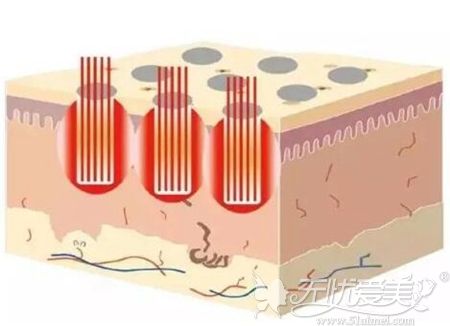 点阵激光改善毛孔原理