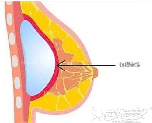 同样假体隆胸手术为什么有人术后有包膜挛缩的表现呢？