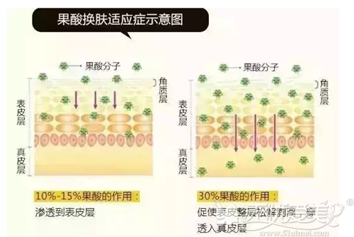 果酸焕肤祛痘示意图