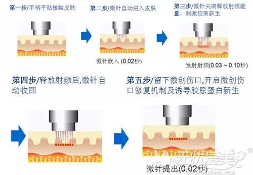 黄金微针祛痘过程