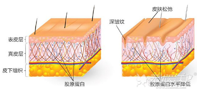 热拉提作用在真皮层